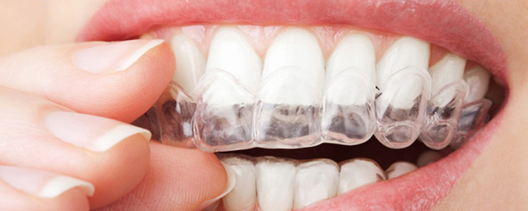 beljenje-zuba02