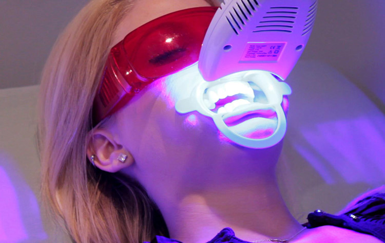 beljenje zuba laserom