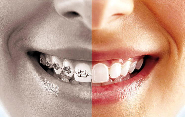 ortodoncija pre i posle